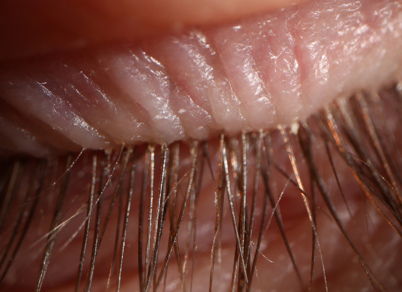 eyelash mites