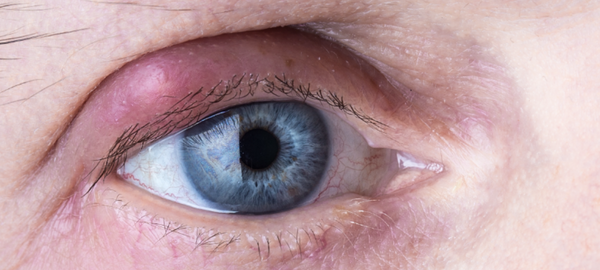 eye stye