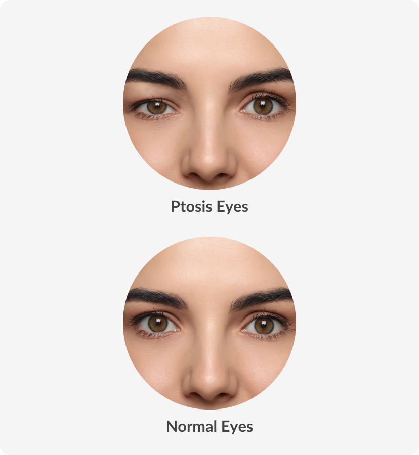 Ptosis