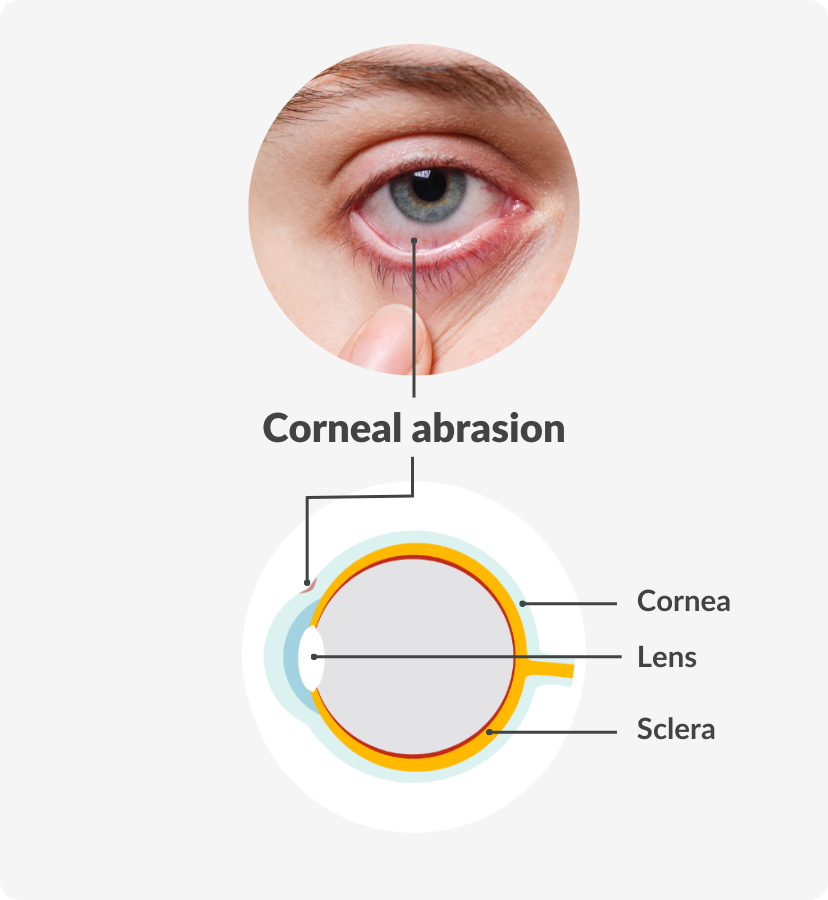 corneal abrasion diagram