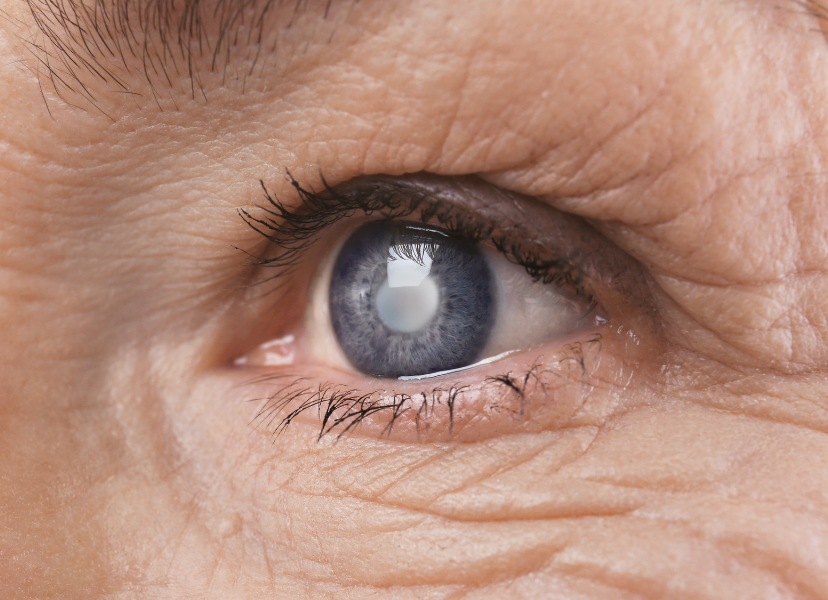 close-up of an eye with a cataract