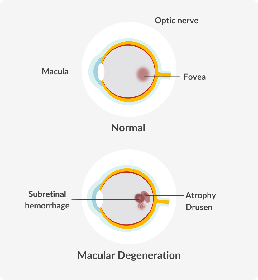diagram of an eye with macular degeneration compared to a normal eye
