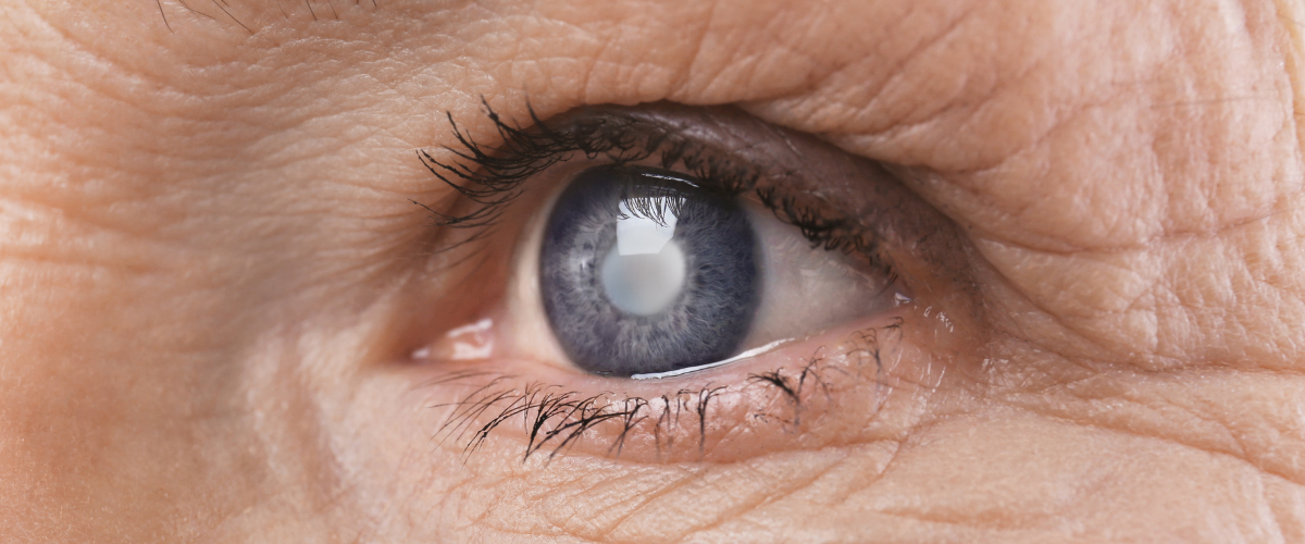 a close-up of an eye with cataracts