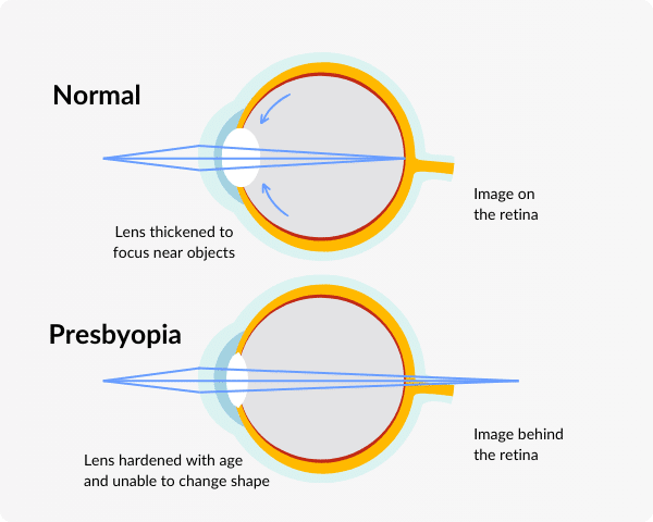 infographic on how presbyopia eye anatomy works