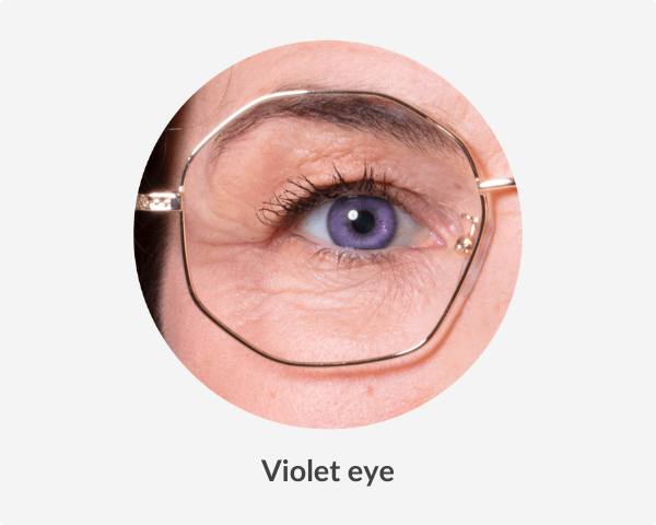 Violet eye