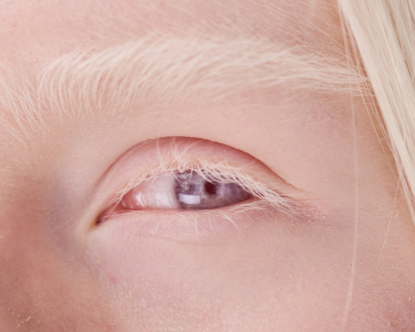 Albino eye