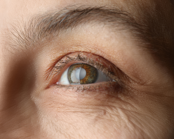 Cataracts eye