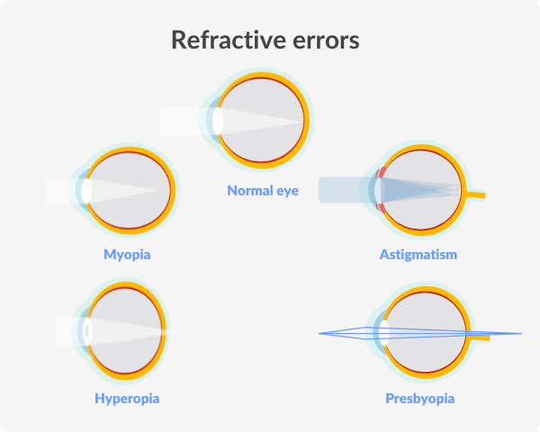 Illustration of what eyeballs with refractive errors look like