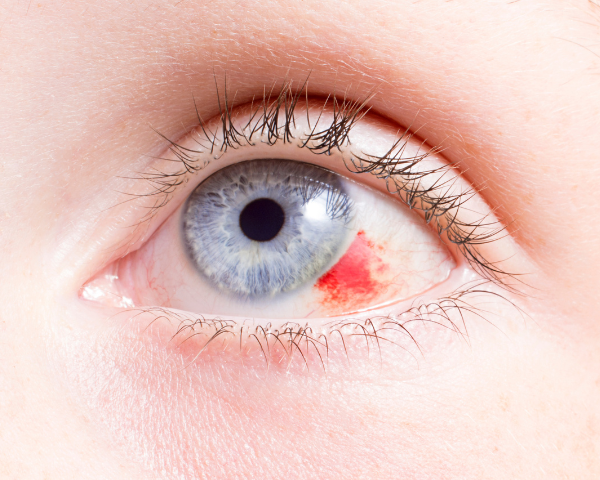 Blue eye up close with patch of redness