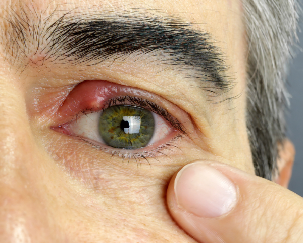 Blepharitis and Stress