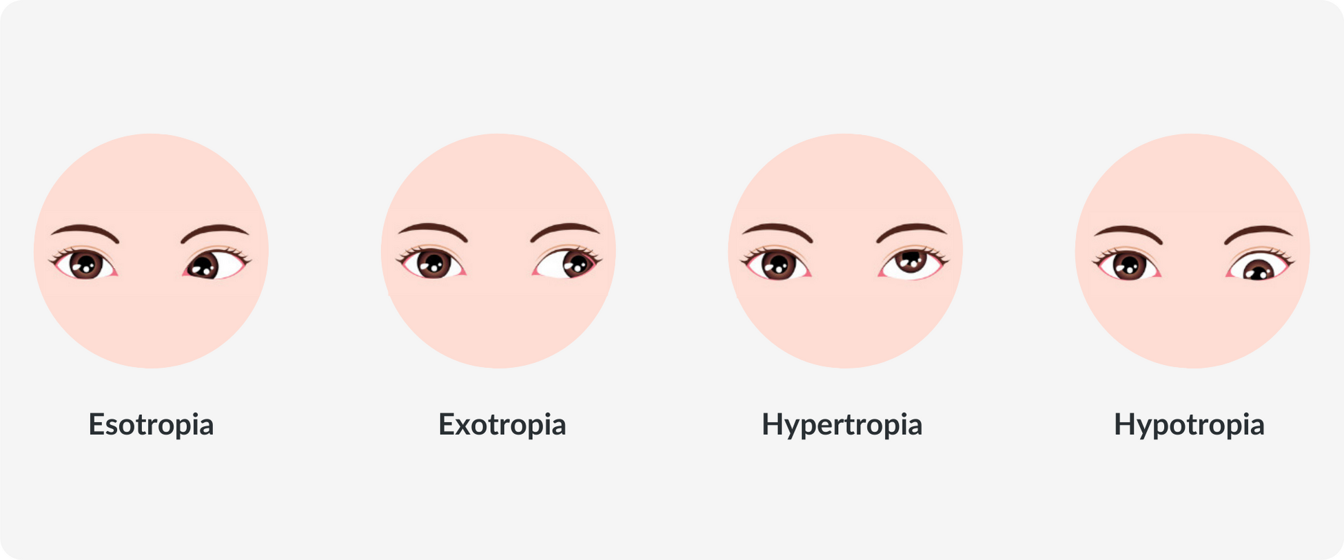 types of strabismus