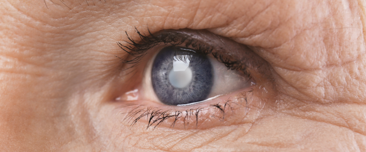 a close up of an eye with cataracts