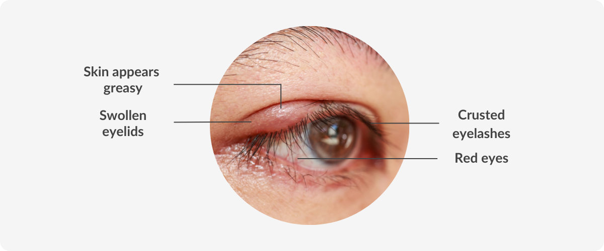 example of eye with blpharitis