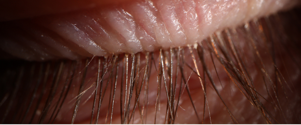 eyelash mites