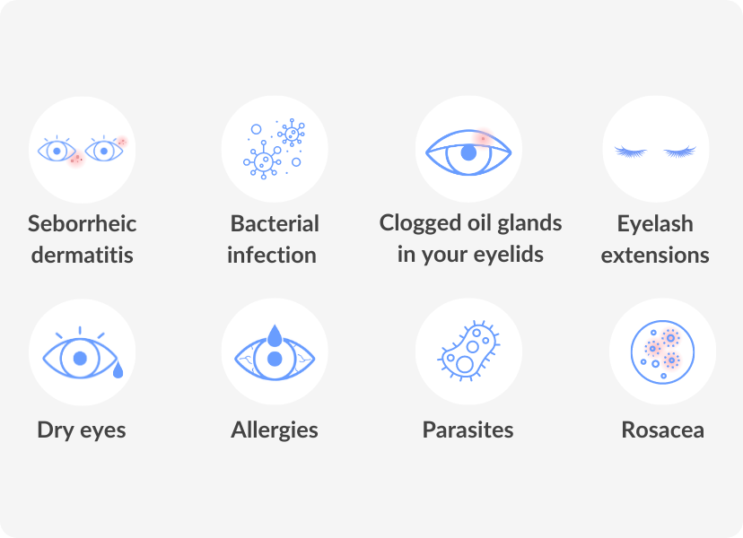 Blepharitis Symptoms Causes And Possible Treatments Smartbuyglasses Us 