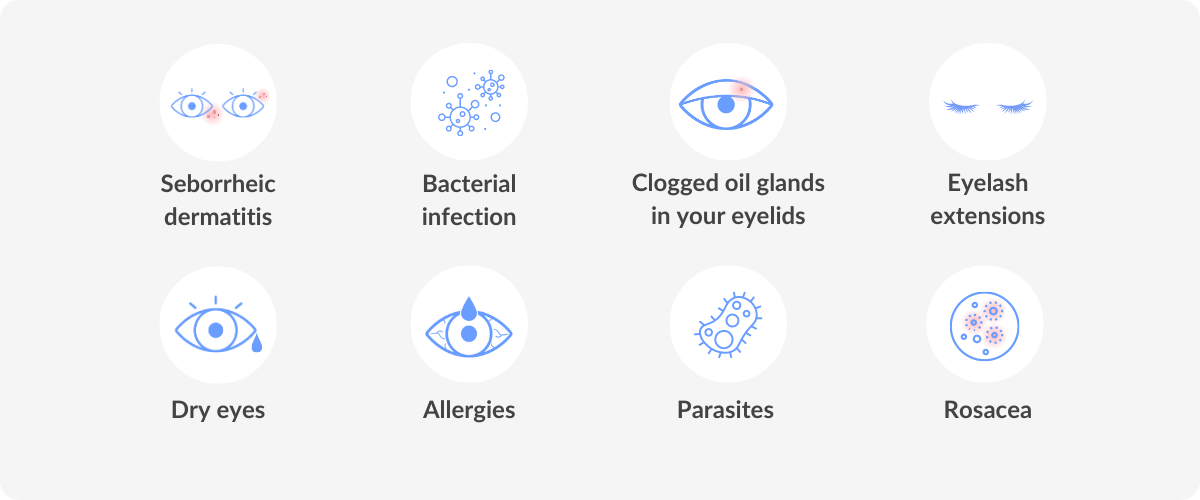 causes of blepharitis