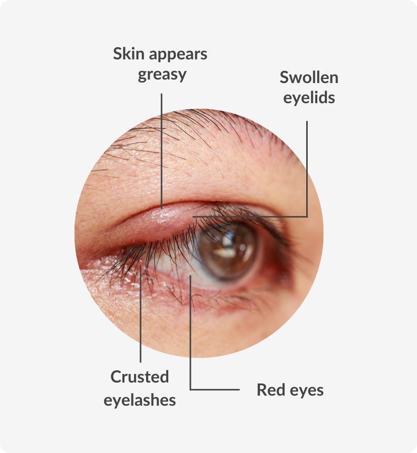 eye with blepharitis