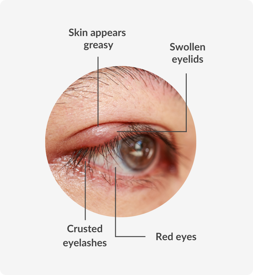 seborrheic blepharitis treatment