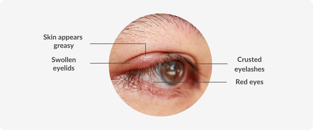 eye with blepharitis