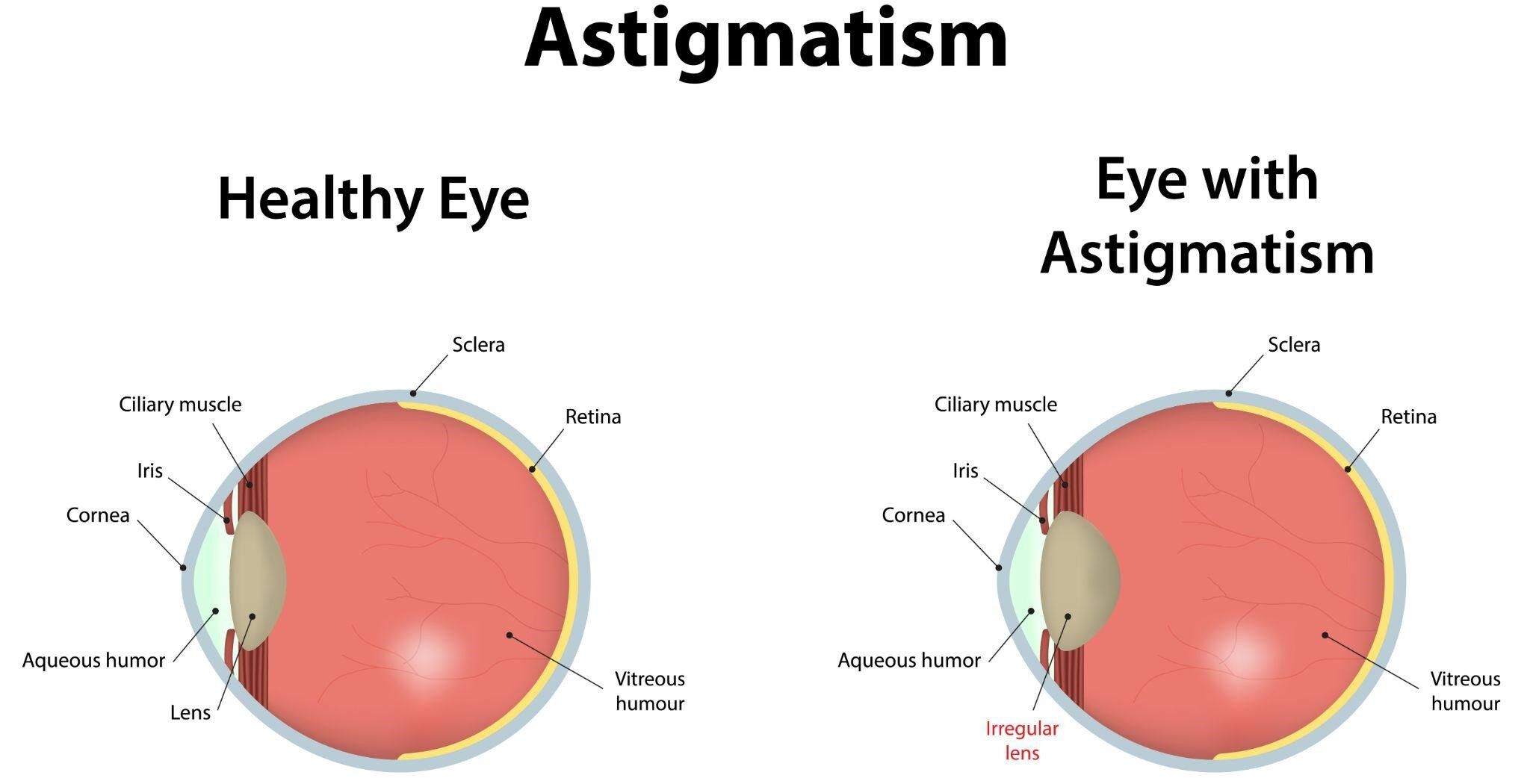 Illustration of a healthy eye and an eye with astigmatism