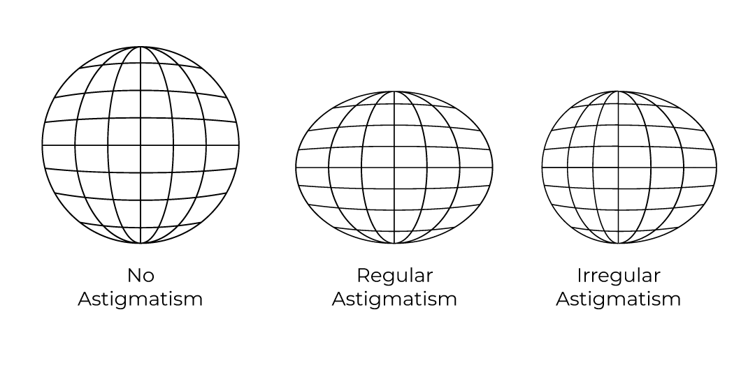 Illustration of the shape of the eye with and without astigmatism