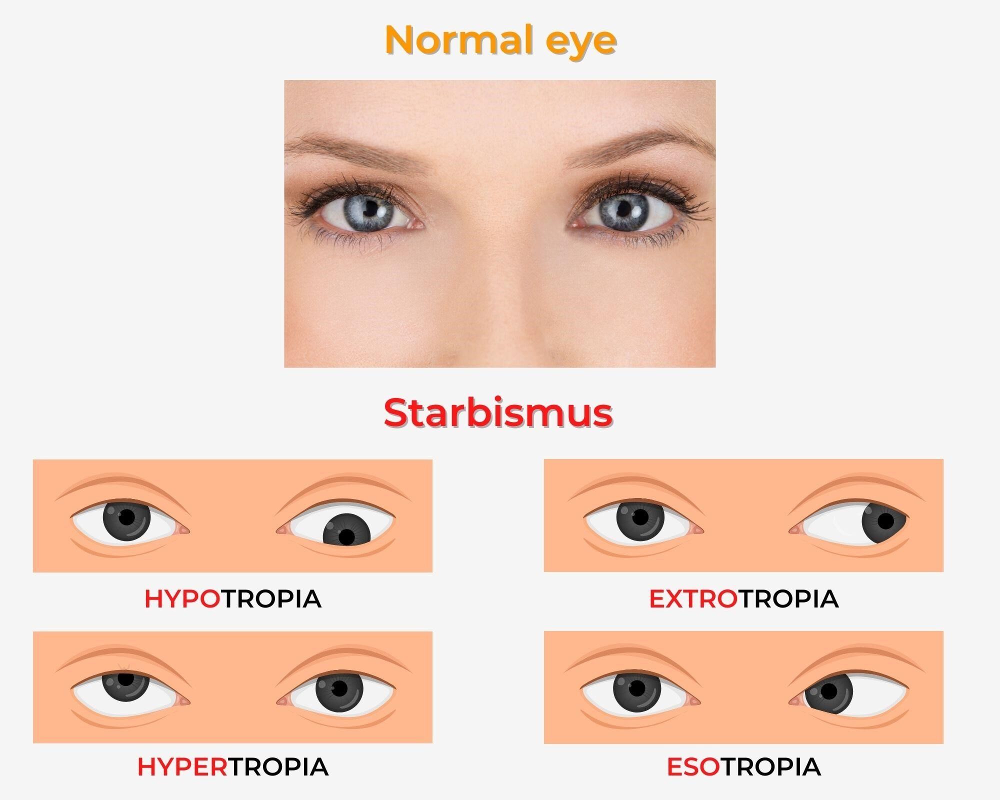 Illustartion of what it looks like to have strabismus