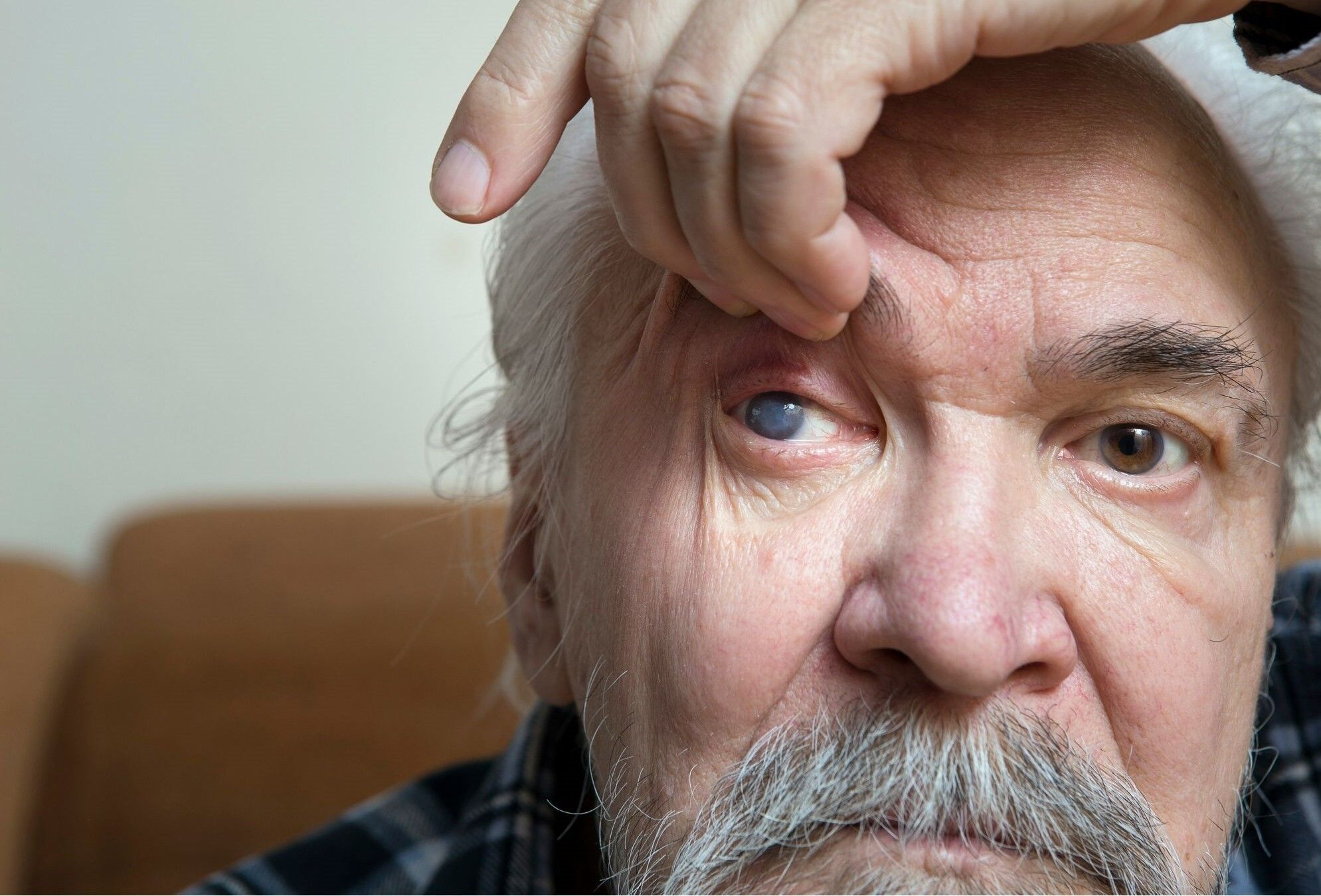 Old man holding up an eyelid showing an eye with cataracts