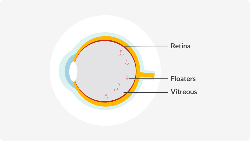 Medical Diagram of Floaters in the eye