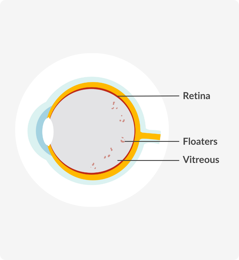 Medical Diagram of Floaters in the eye