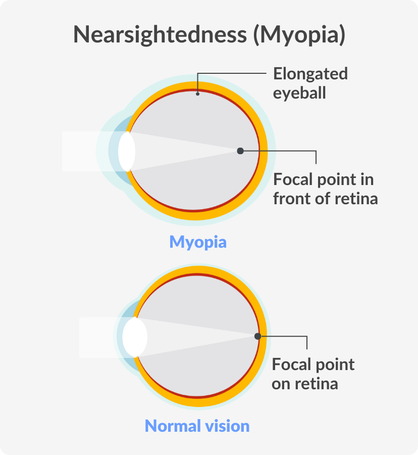 myopic eye diagram