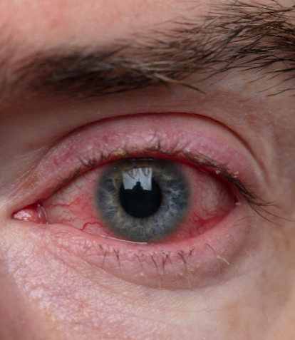 What Causes Bloodshot Eyes Smartbuyglasses Us