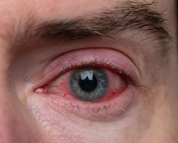 What Causes Bloodshot Eyes