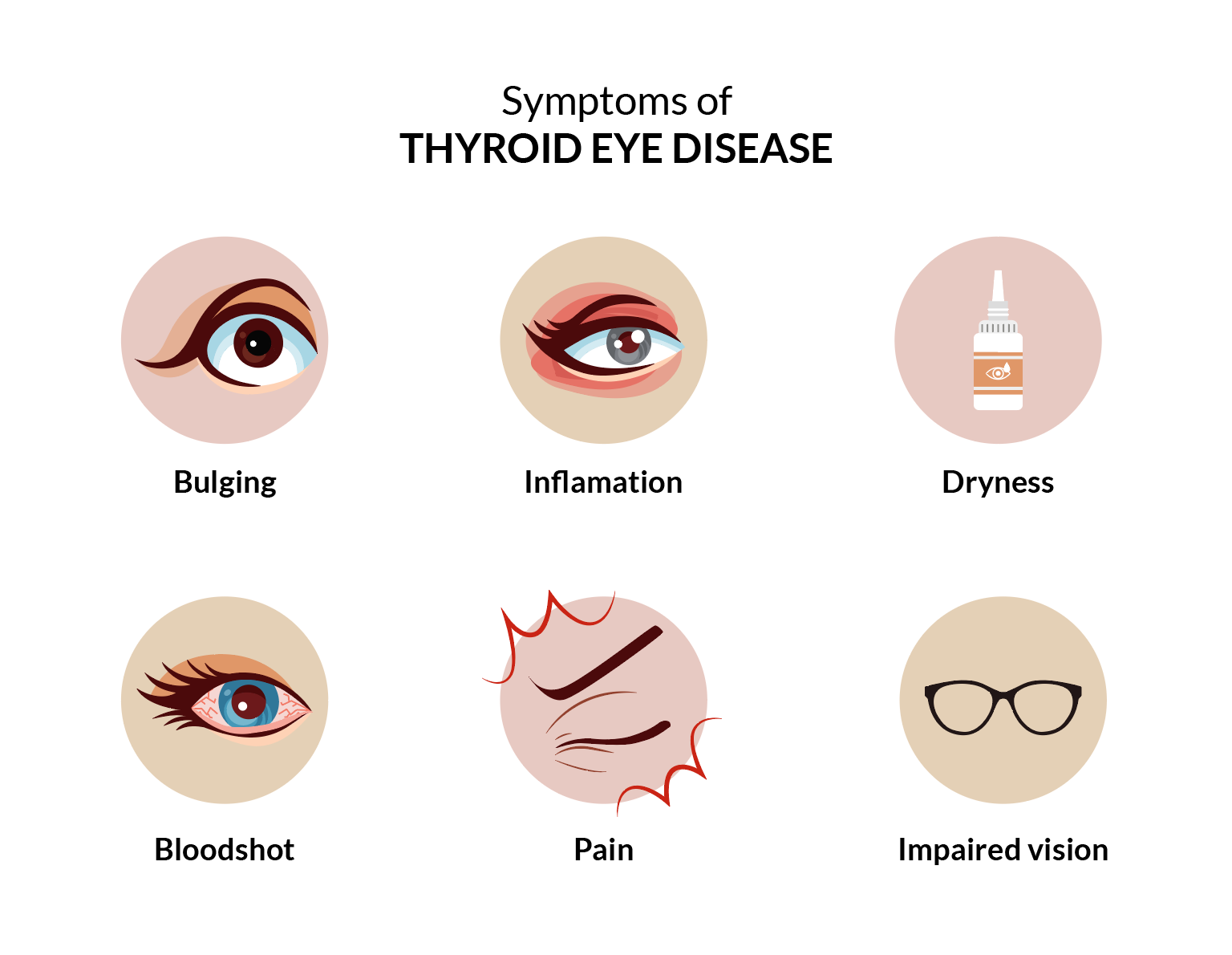 What Is Thyroid Eye Disease? | SmartBuyGlasses US