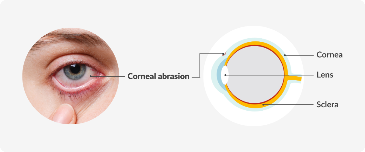 diagram of a scratched cornea