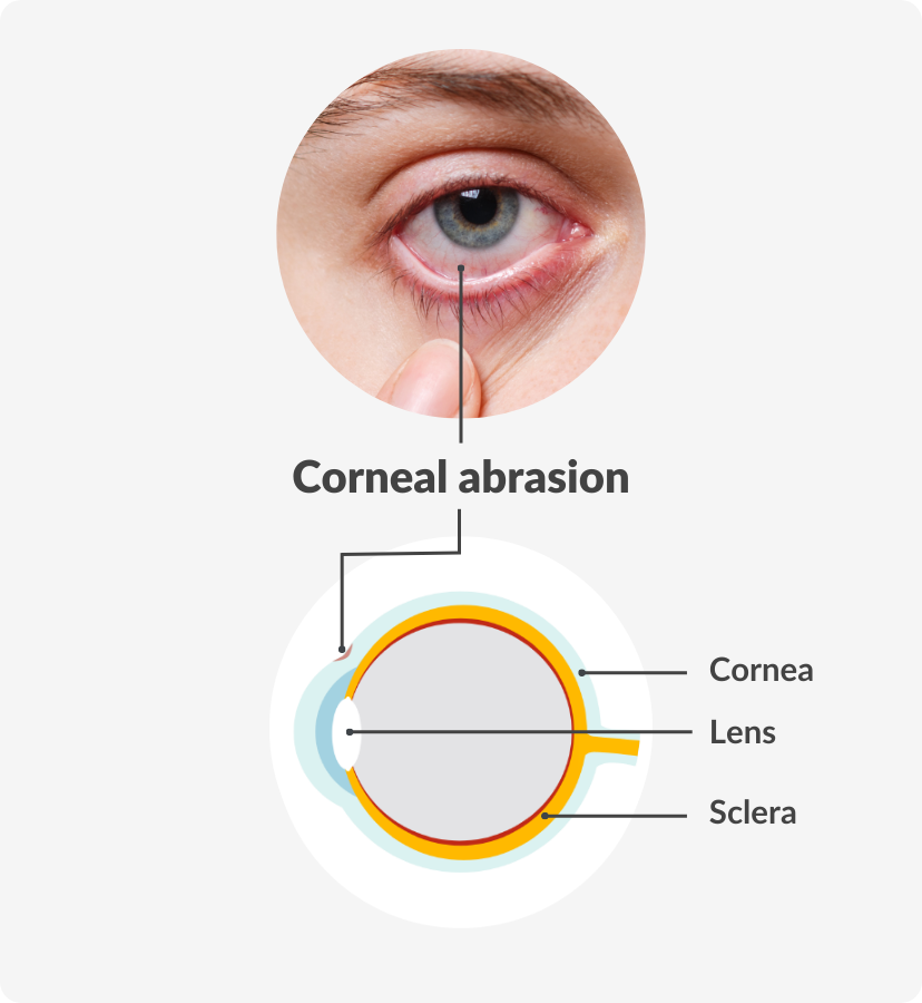 diagram of a scratched cornea