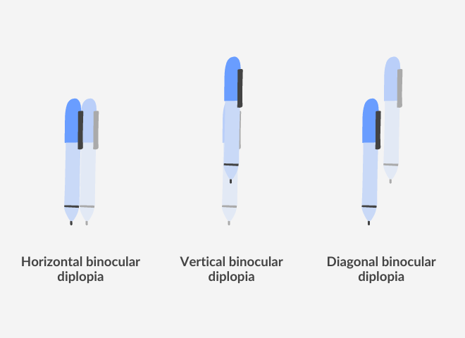 visual representation of the types of binocular diplopia