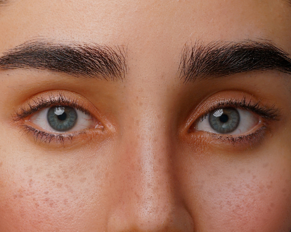 Close-set eyes