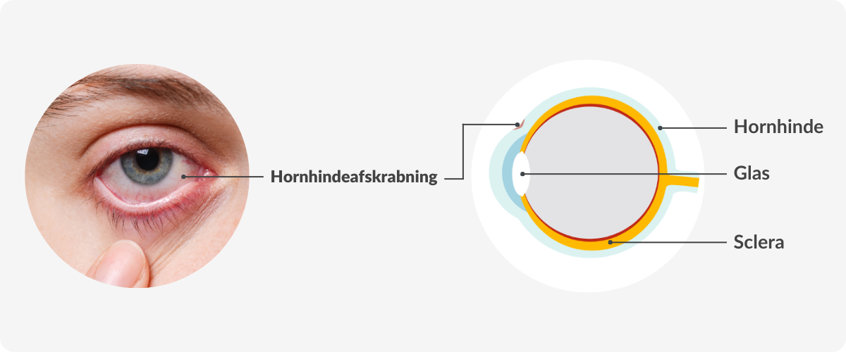 corneal abrasion diagram