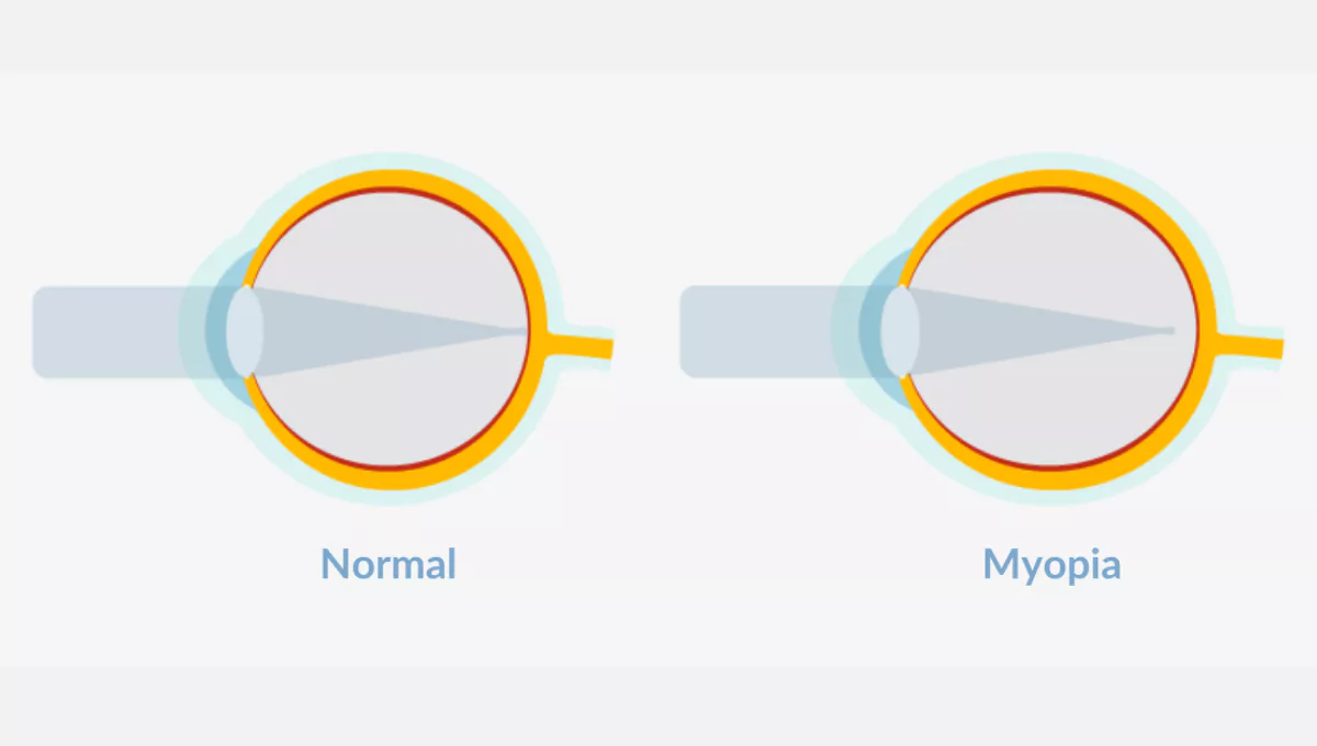 myopia