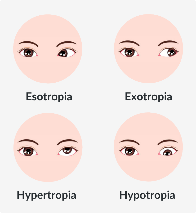 types of strabismus