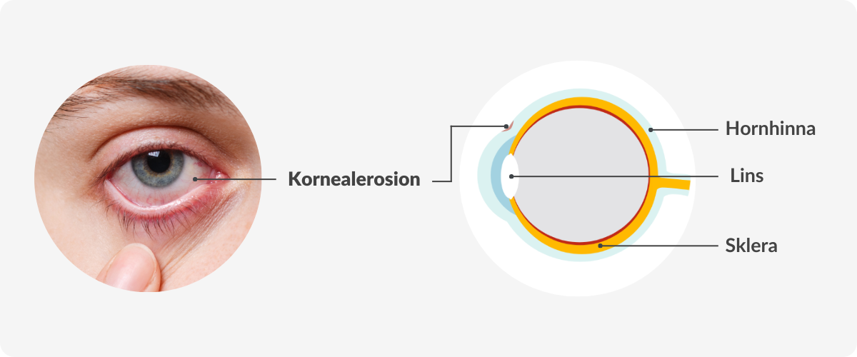 corneal abrasion diagram