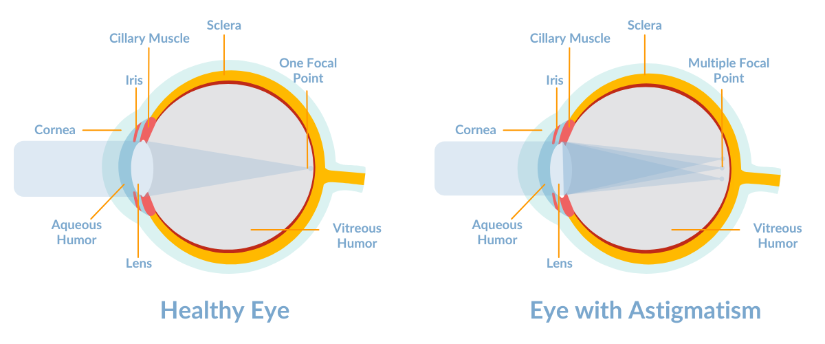 Astigmatism: causes, types, symptoms & treatment | Vision Direct AU