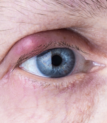 How To Get Rid of a Stye | Vision Direct AU