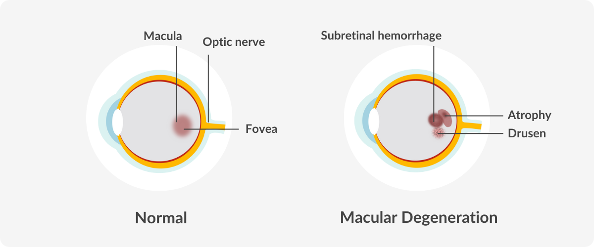 digram of an eye with macular degeneration compared to a normal eye