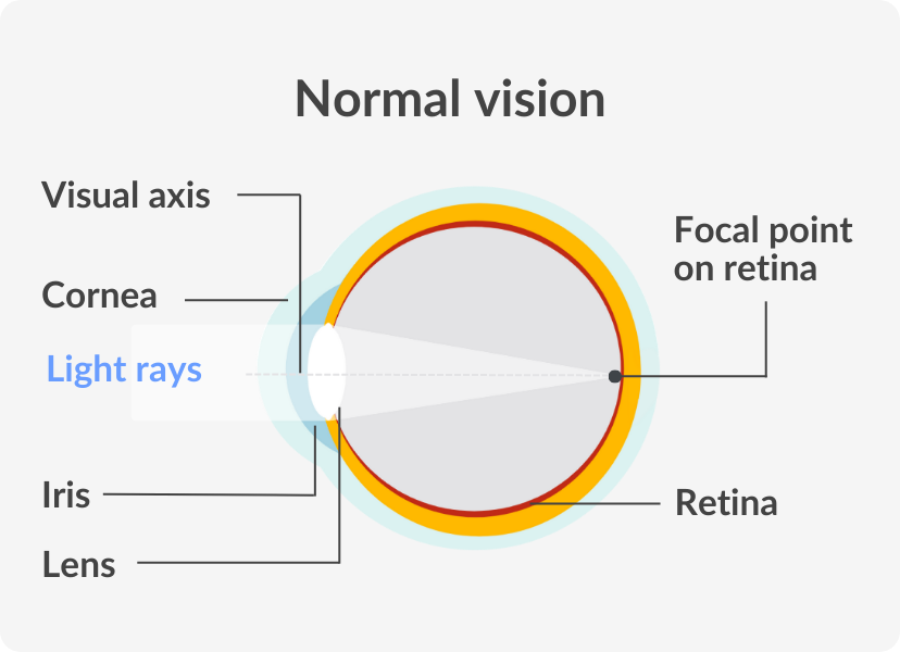 LASIK Eye Surgery Optical Centre Vision Direct AU