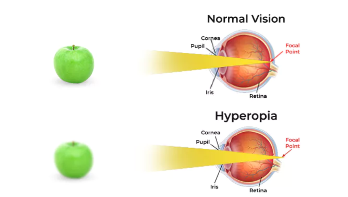 hyperopia