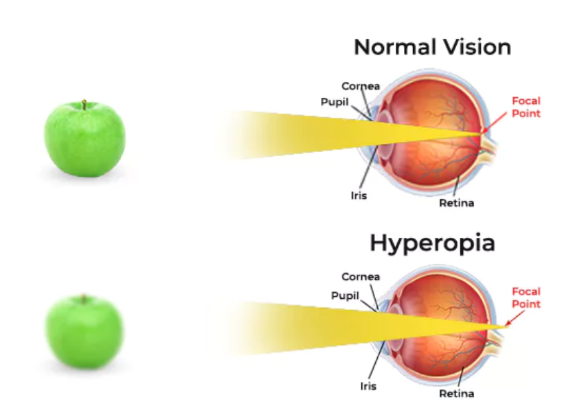 hyperopia