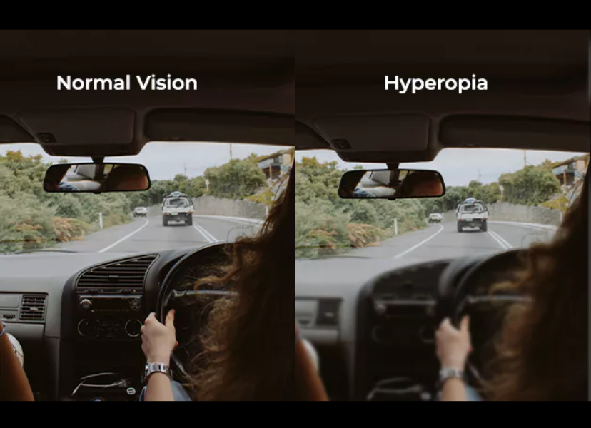 Hyperopia Vision