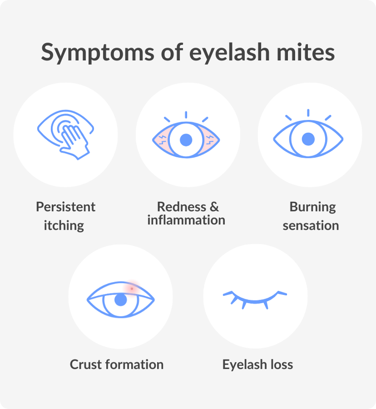 Eyelash Mites Symptoms, Causes and Treatment Vision Direct AU
