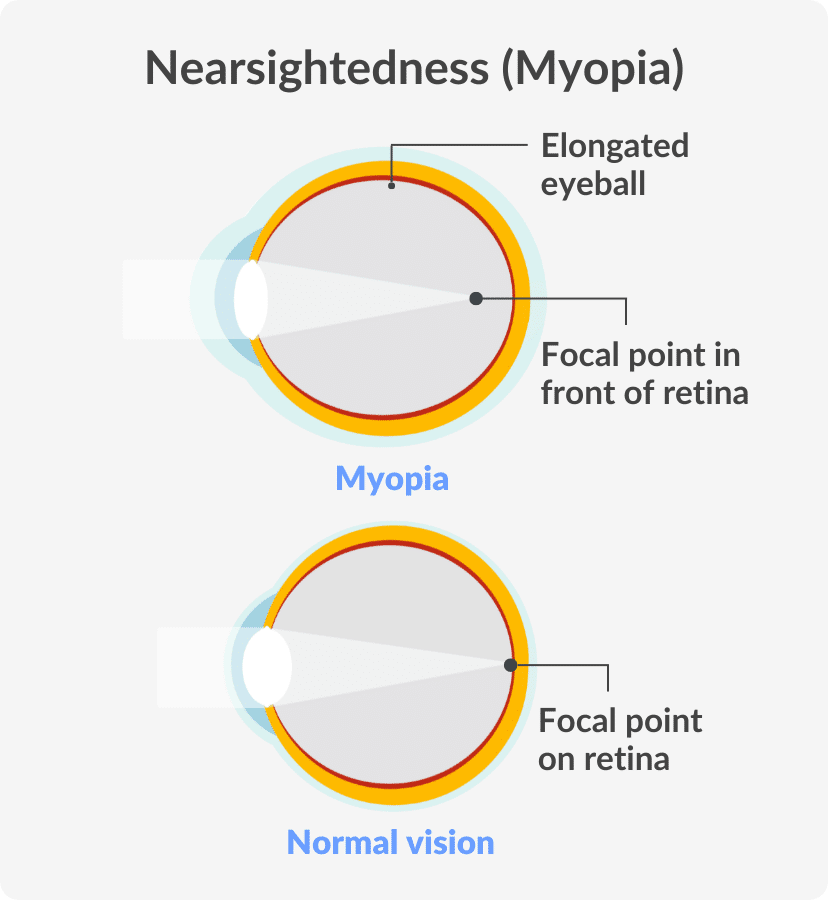 infographic explaining eye anatomy in myopia patients